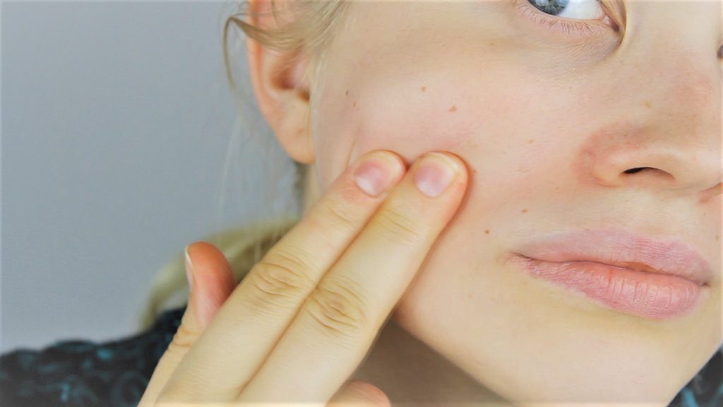 Treat Acne Naturally, Organic Skincare, Fix Acne, Cure Acne