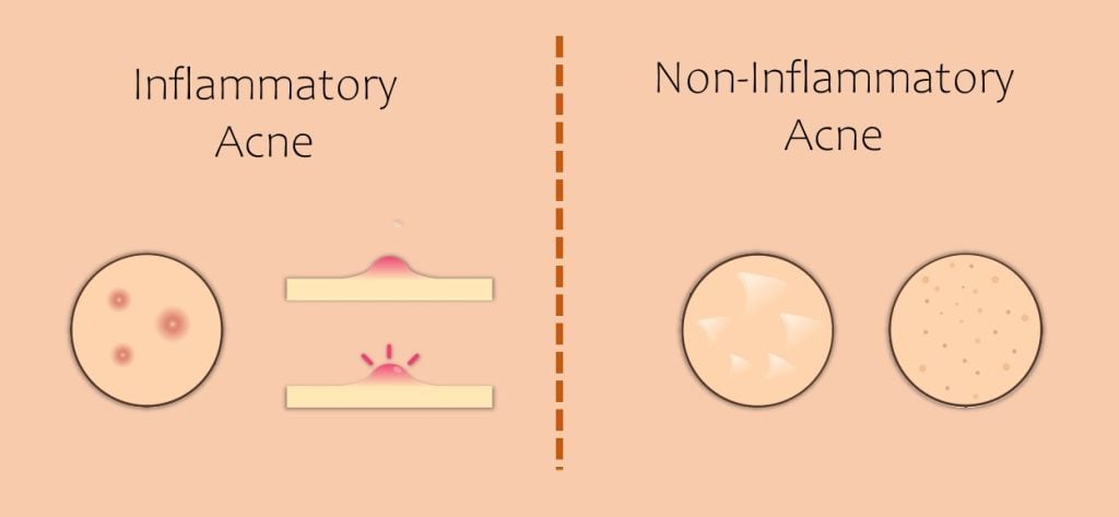 acne-prone skin-types of acne