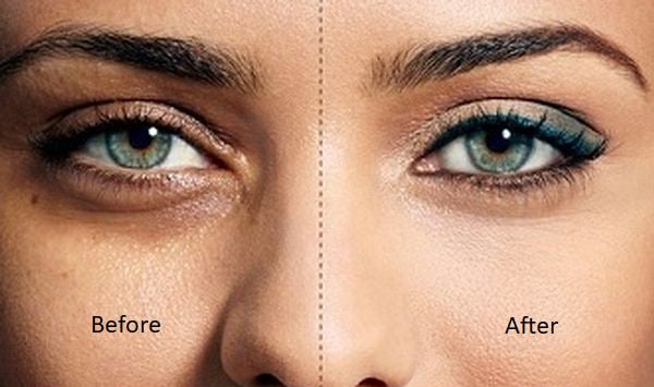 how to get rid of under eyes dark circles