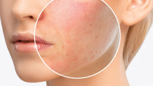 The Main Cause of Allergic Reactions in Skin Care Products