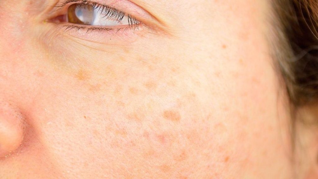 how to get rid of age spots naturally